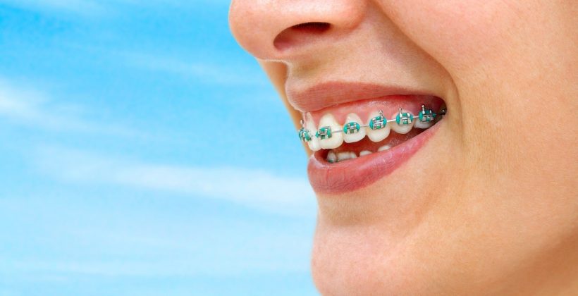 ทันตกรรมจัดฟัน (Orthodontics)
