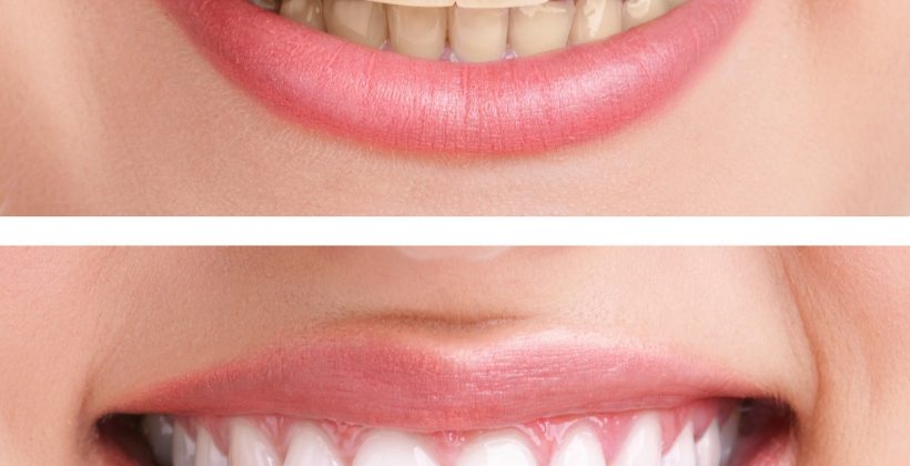 การฟอกฟันขาว (Tooth whitening)