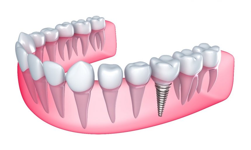 รากฟันเทียม (Dental Implant)