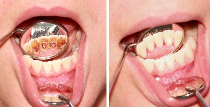 โรคเหงือก (Gum disease)